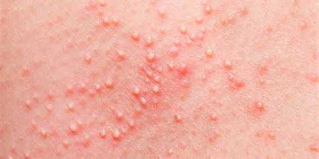 Yaz sonu ve sonbahar başında güneş alerjisine dikkat