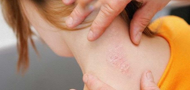 Sedef Hastaligina Ne Iyi Gelir Sedef Hastaligina Ne Iyi Gelir