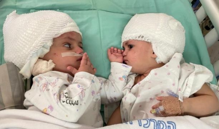 İsrail’de yapışık ikizler 12 saatlik operasyonla ayrıldı