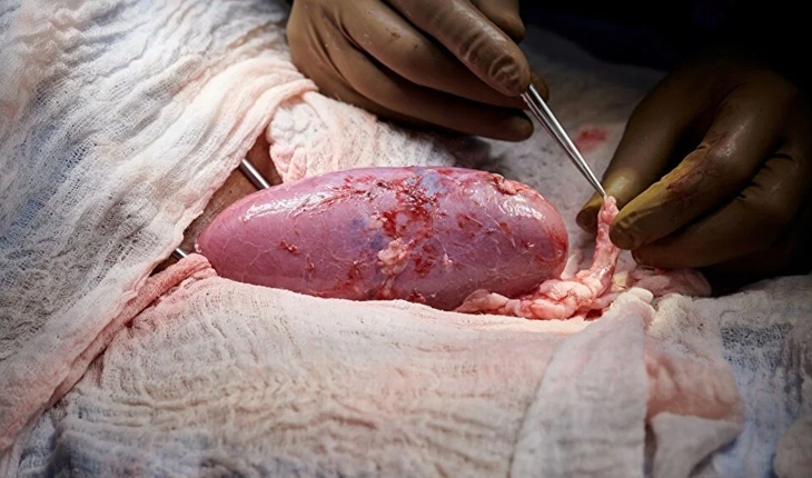 Dünyada ilk kez hayvandan alınan organ bir insana başarıyla nakledildi