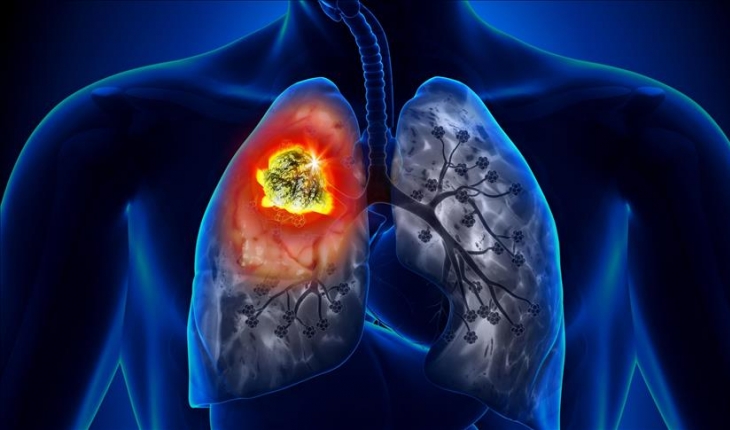 Yılda 27 binden fazla kişiye “akciğer kanseri“ teşhisi konuluyor