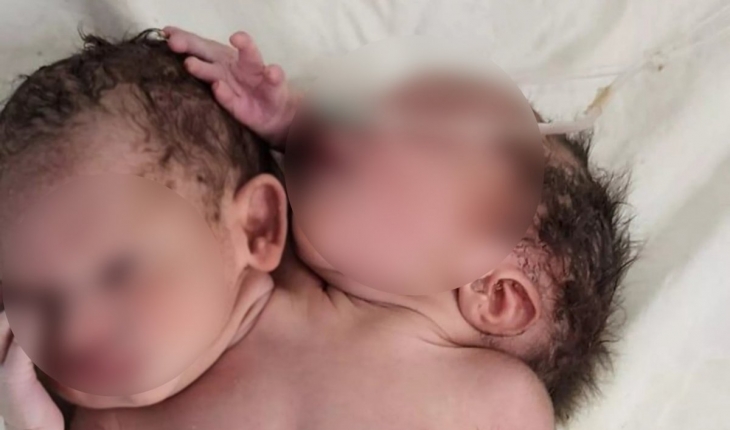 Hindistan’da çift başlı bebek dünyaya geldi