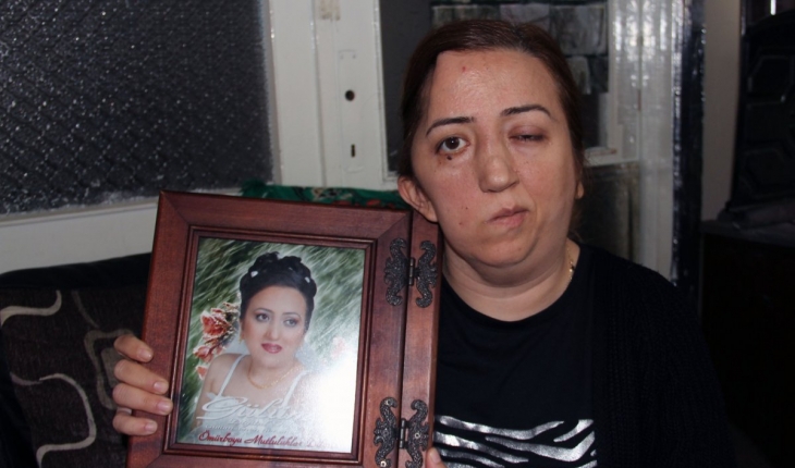 Giresunlu hemşire ameliyat sonrası felç geçirdi, kafatası kayboldu