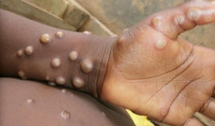 Maymun çiçeği virüsü yayılıyor: 5 ülkede görüldü