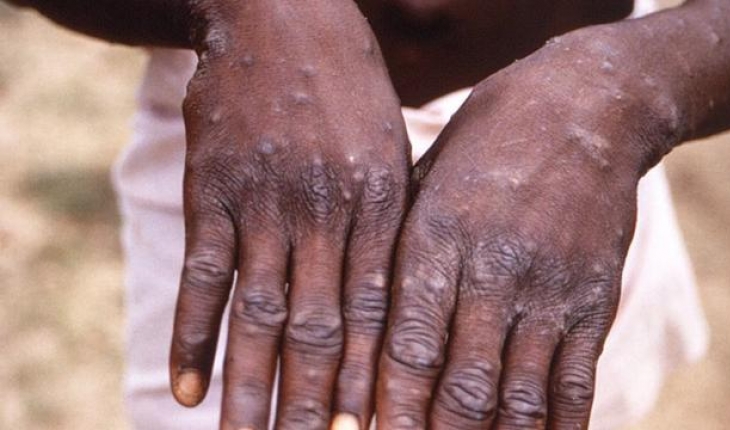 Bakanlık açıkladı: 'Maymun çiçeği' Türkiye'de görüldü mü?