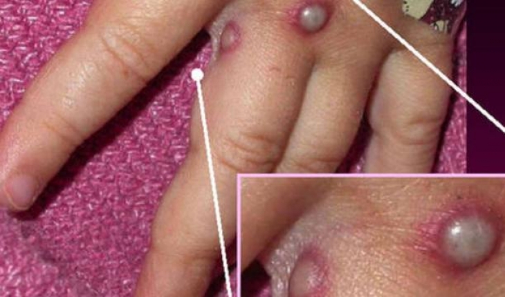 Maymun çiçeği ile ilgili bilinmesi gerekenler: Çiçek aşısı çare olabilir