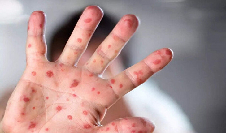 16 ülkede 250'den fazla maymun çiçeği vakası görüldü