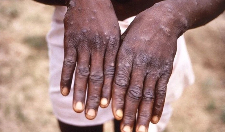 Maymun çiçeği virüsü nedir? Maymun çiçeği virüsü belirtileri neler? Türkiye’de görüldümü?