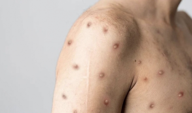 Maymun çiçeği virüsünün ismi değiştiriliyor