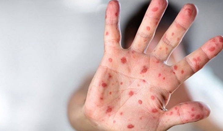 Türkiye'deki maymun çiçeği vaka sayısı 11'e yükseldi