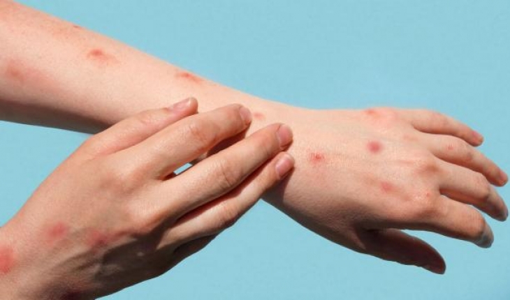 Dünyada maymun çiçeği vaka artışları son bir haftada yüzde 21 azaldı