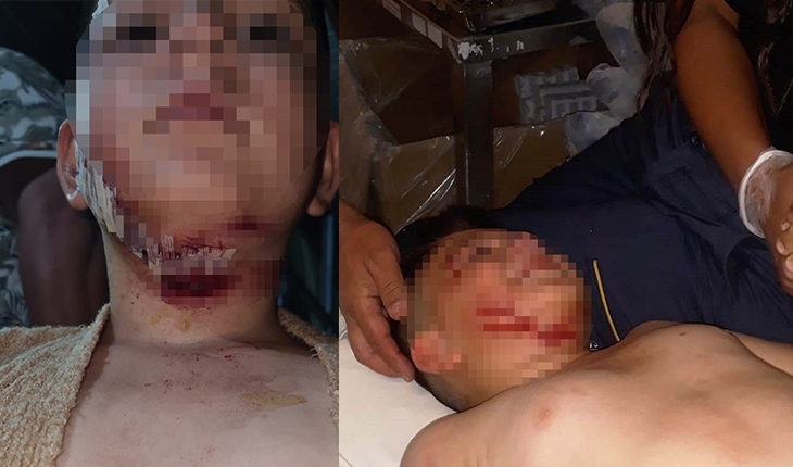 Konya’da köpeğin saldırdığı 9 yaşındaki çocuğa 40 dikiş atıldı