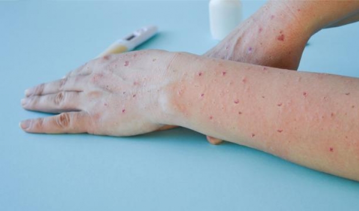 DSÖ, maymun çiçeği virüsünün adını "Mpox" olarak değiştirecek