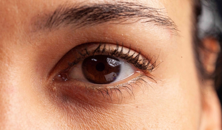 Göz Altı Morlukları Neden Olur?