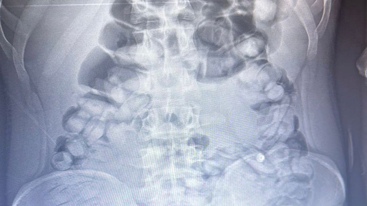 Yolcunun midesinden 1 kilo 134 gram sakız çıktı