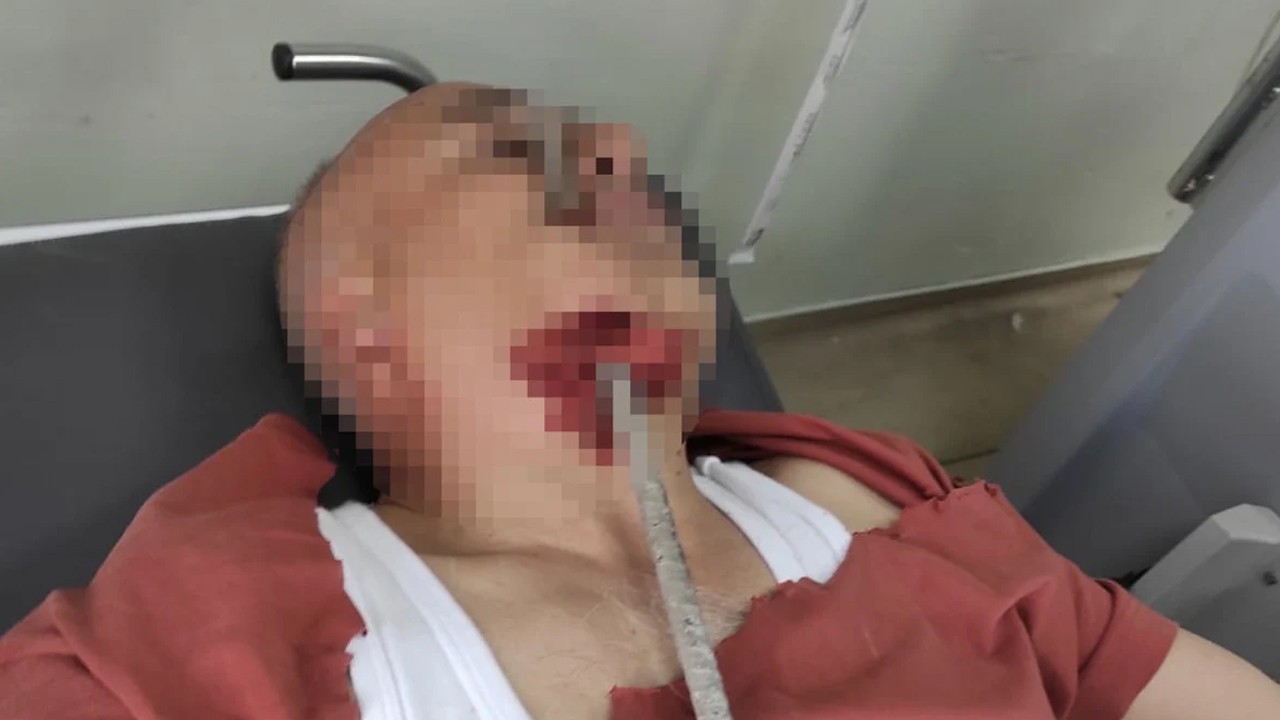 Şantiyede ayağı kayıp düşen işçinin yüzüne inşaat demiri saplandı