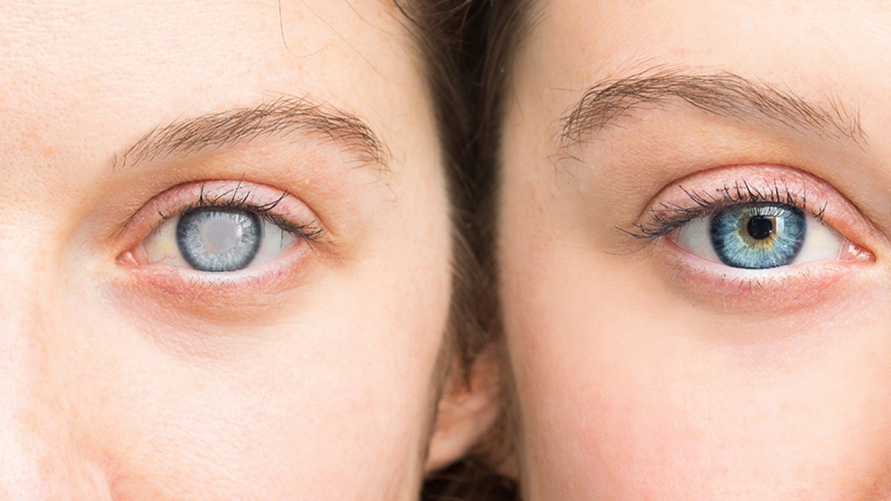 Katarakt Nedir ve Neden Oluşur?