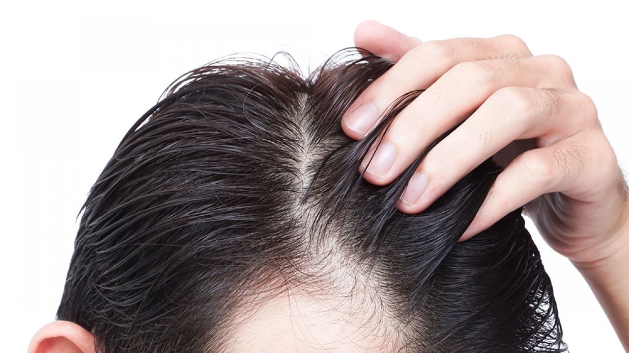 Saç Ekimi Nedir ve Nasıl Yapılır?