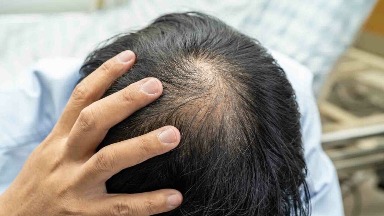 DHI saç ekimi nedir ve diğer yöntemlerden farkı nedir?