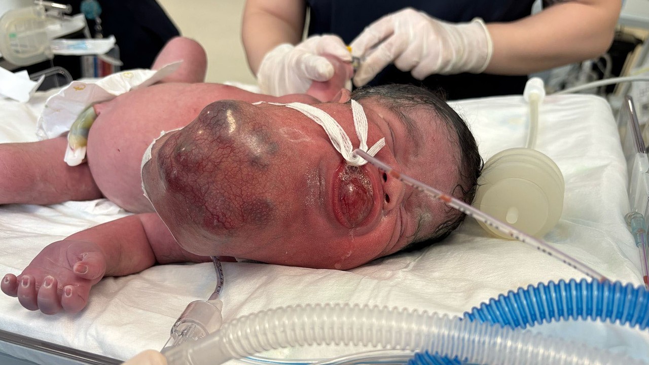 Dünyada yedinci vaka! 34 haftalık doğan bebeğin boynundan 445 gram tümör çıkarıldı
