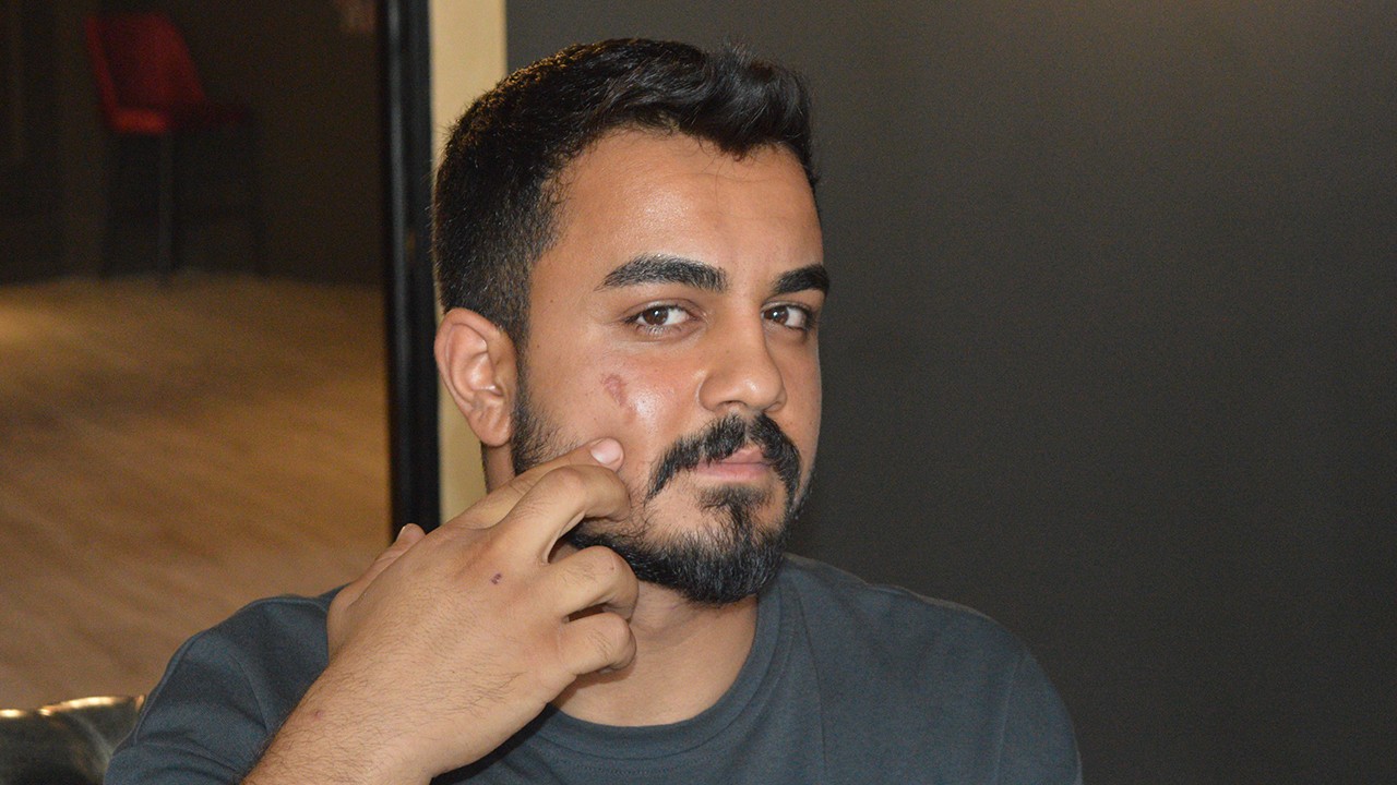 Lazer epilasyonda yüzü yandı