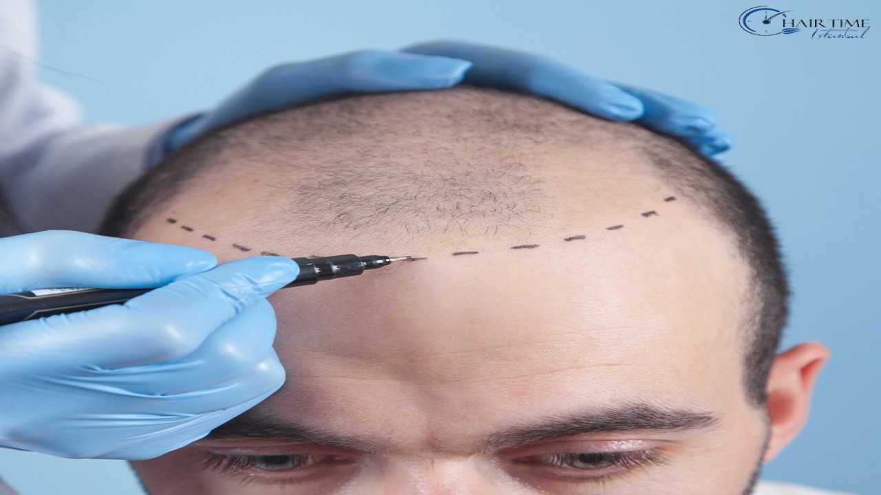 Haartransplantatie Nederland: Kosten 2025, Methoden en Alles Wat U Moet Weten