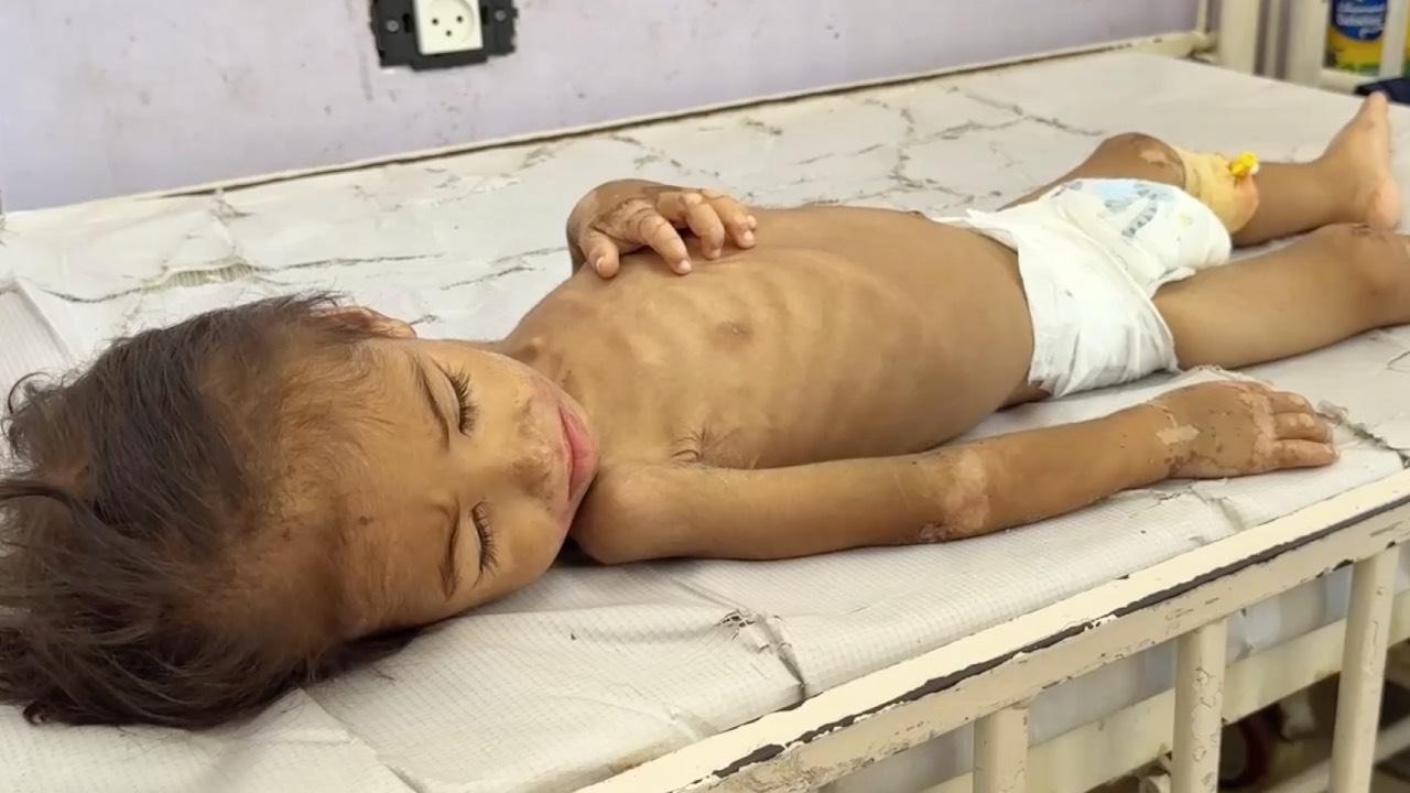 DSÖ: Gazze Şeridi'nde yetersiz beslenmeye bağlı 400 ölüm doğrulandı