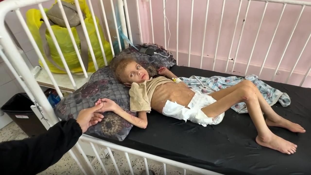 DSÖ: Gazze'de son 2 ayda 10 bin çocuğa akut yetersiz beslenme teşhisi konuldu