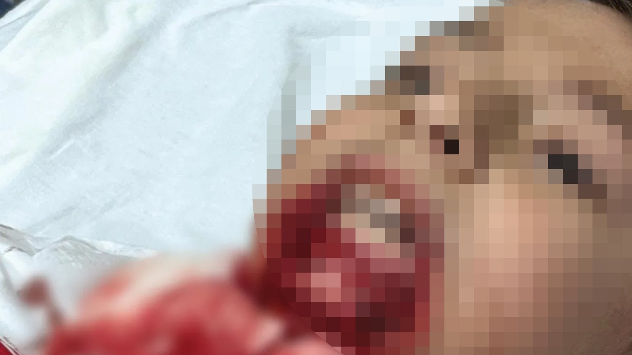 Okulda çenesine demir saplandı: Öğrencinin çenesi koptu