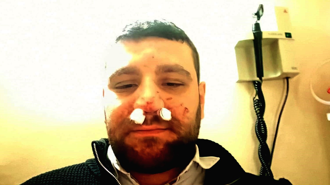 Trafikte yol verme tartışmasında avukatın burnu kırıldı