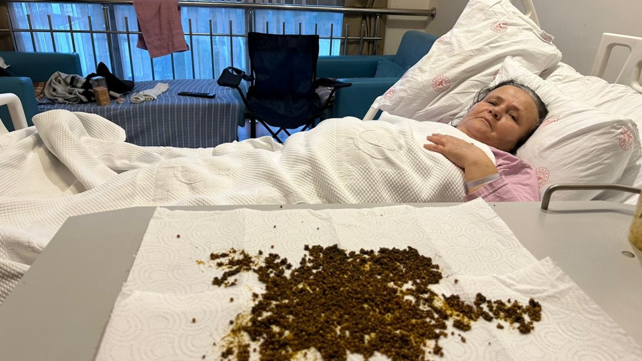 Sağlık ekibi hayrete düştü! 20 binden fazla taş çıkarıldı