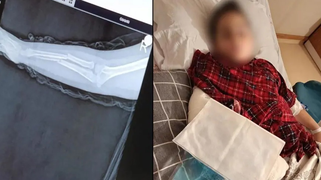 Okulda akran zorbalığı!  9 yaşındaki çocuk arkadaşının kolunu kırdı