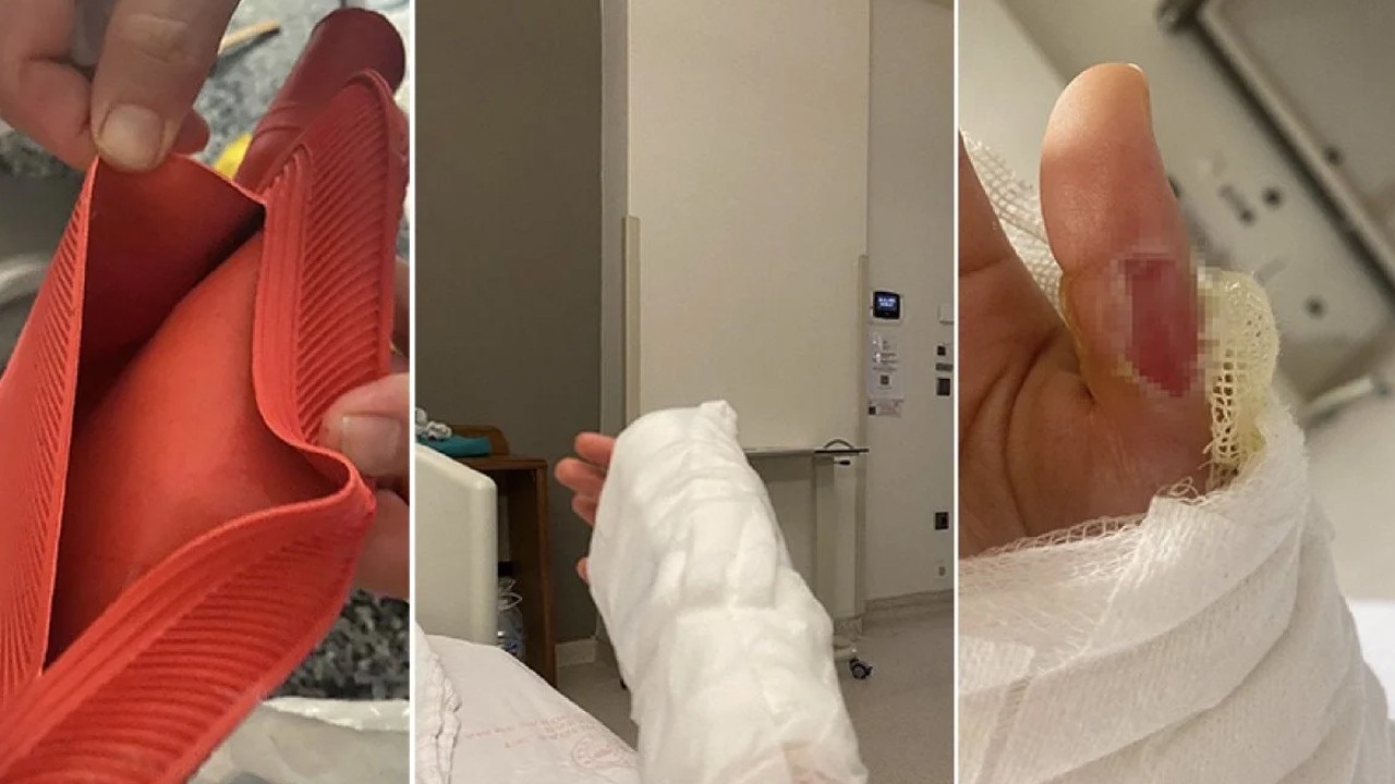 Sıcak su torbası patladı: Genç kızın vücudunun yüzde 25'i yandı