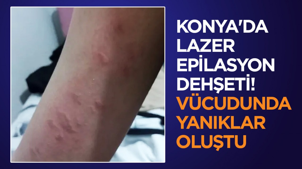 Konya'da lazer epilasyon dehşeti ! 17 yaşındaki kızın Vücudunda yanıklar oluştu