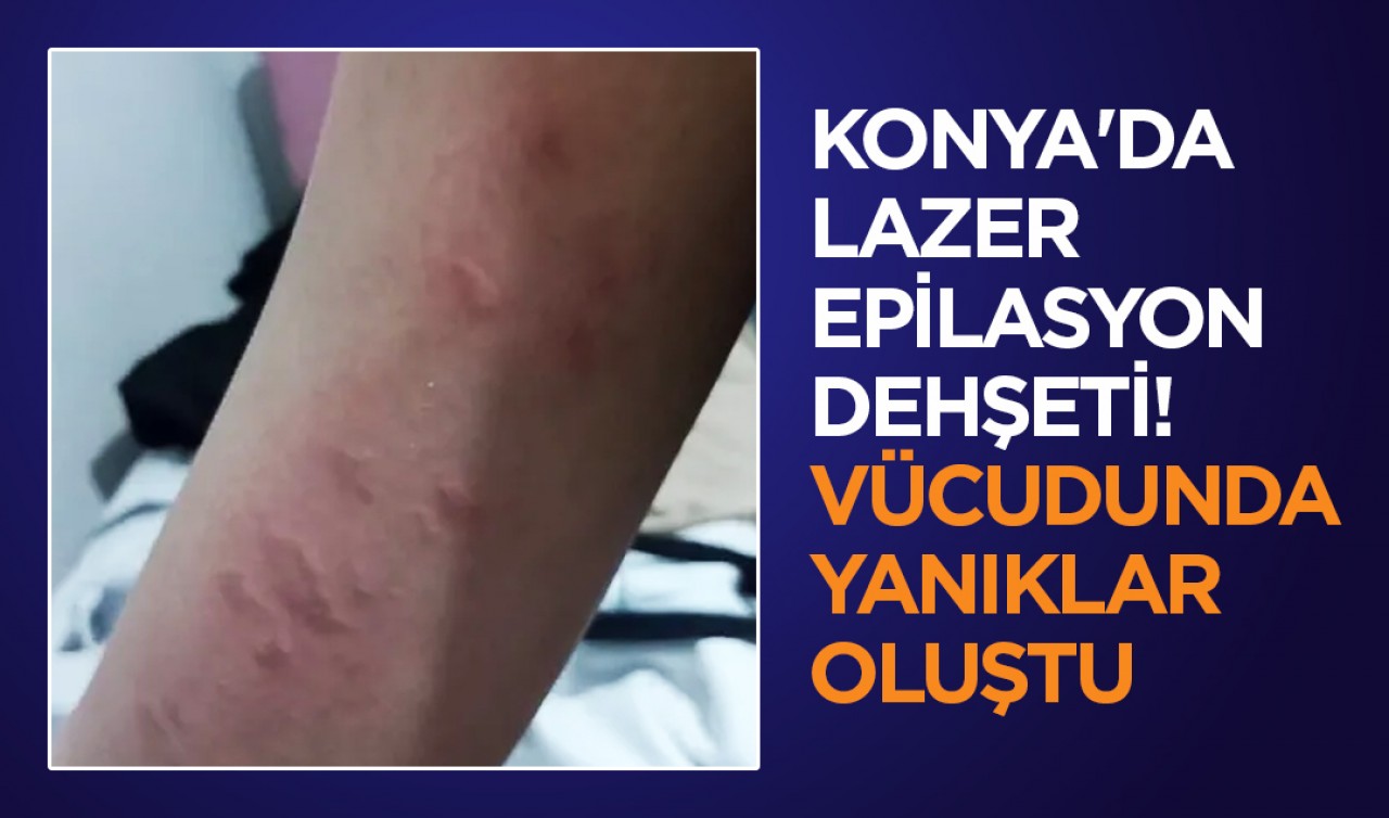 Konya'da lazer epilasyon dehşeti ! 17 yaşındaki kızın Vücudunda yanıklar oluştu