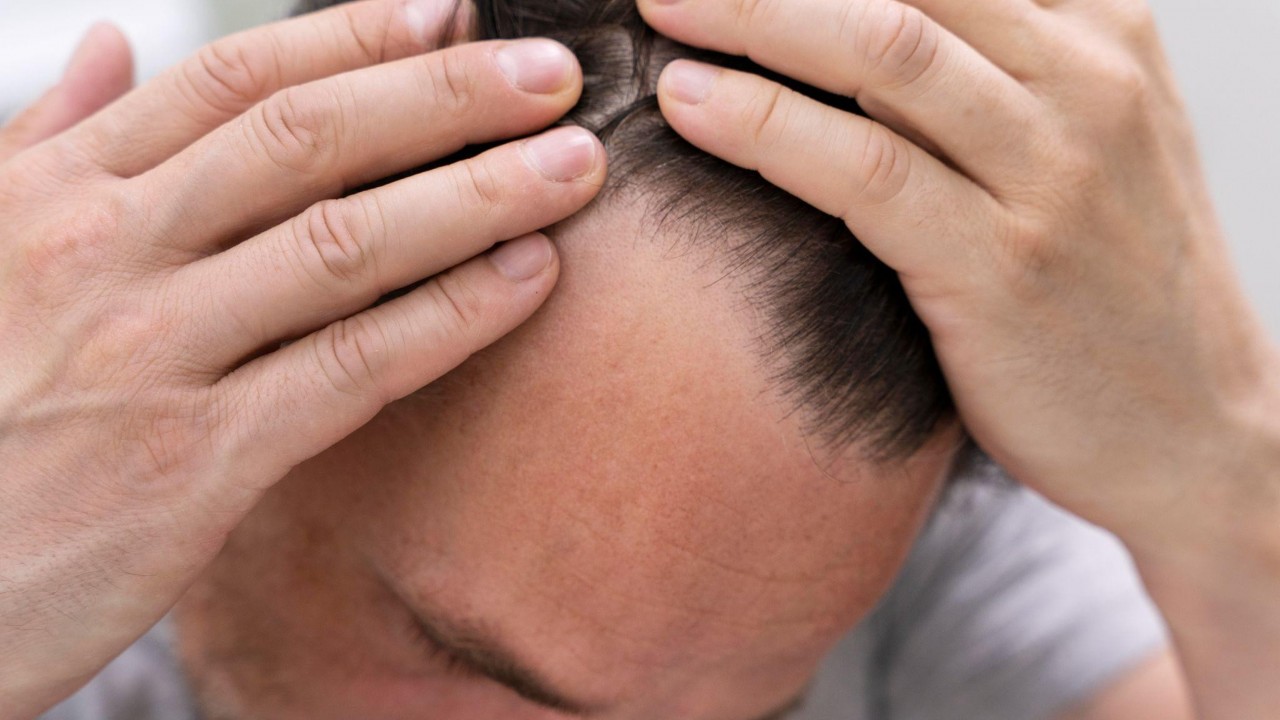 Saç Dökülmesine Karşı Bakım Nasıl Yapılır?