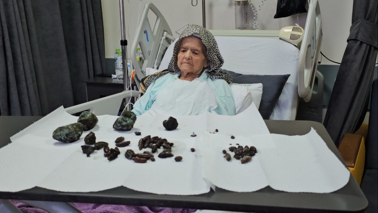 Şubat 2025’te, Zonguldak’ta karın ağrısı ve kusma şikâyetiyle hastaneye gelen 92 yaşındaki Şerife Ay’ın midesinden ve bağırsağından ameliyatla hangisi çıkartılmıştır?  Milyoner Sorusu