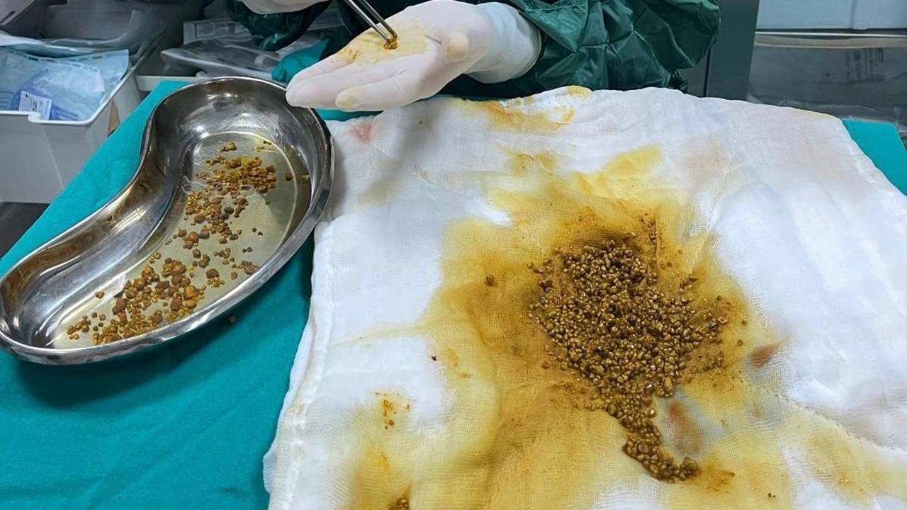 Karın ağrısıyla hastaneye giden hastanın karnından 2 bin 67 taş çıkarıldı