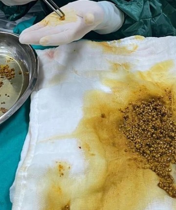 Karın ağrısıyla hastaneye giden hastanın karnından 2 bin 67 taş çıkarıldı