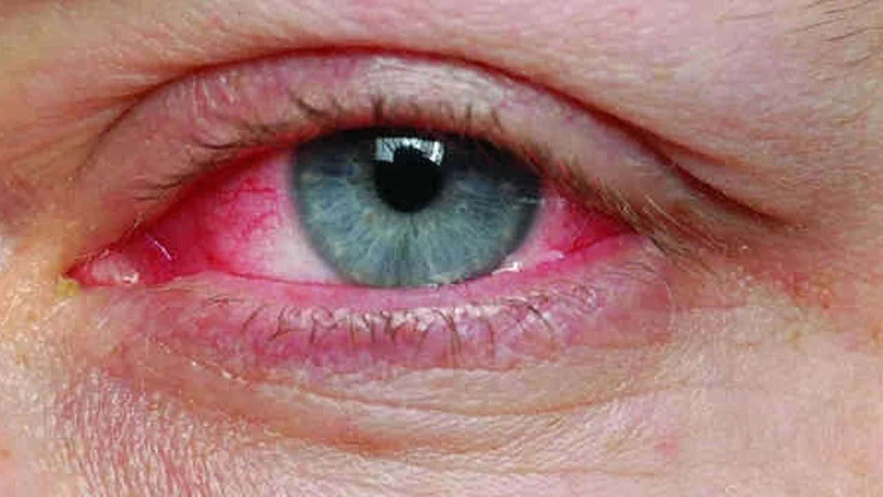 Göz nezlesine dikkat! Bahar alerjisi gözleri vuruyor