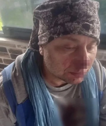 Ünlü sanatçı pitbull saldırısında hastanelik oldu