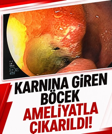 Karnına giren böcek ameliyatla çıkarıldı!