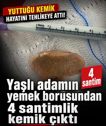 Yaşlı adamın yemek borusundan 4 santimlik kemik çıktı