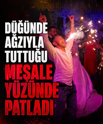 Düğünde ağzıyla tuttuğu meşale yüzünde patladı